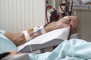 왼쪽팔목에 혈액투석장치를 꽂고 있는 사람의 신체 사진
